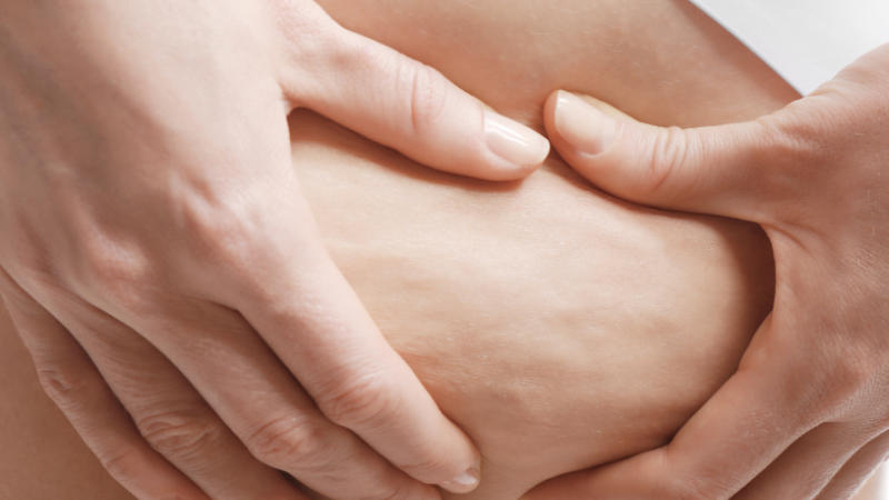 Cellulite zomer